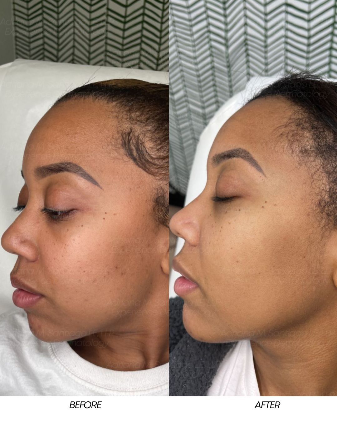 Side-by-side before and after profile photos of a woman, showing smoother skin in the after image.