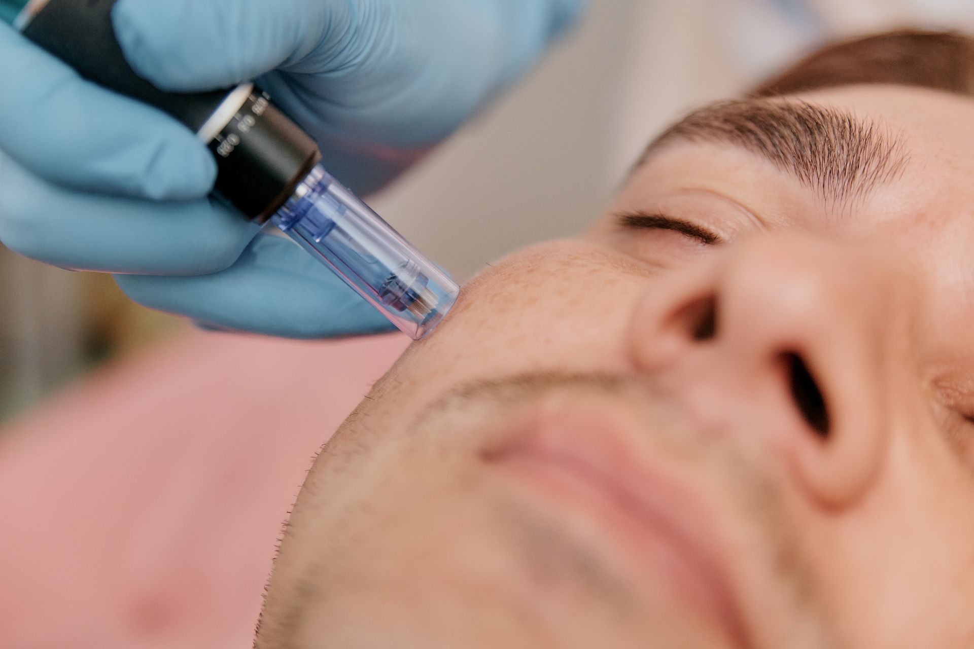 Gloved hand performing microneedling on a person’s cheek with a blue pen-like device
