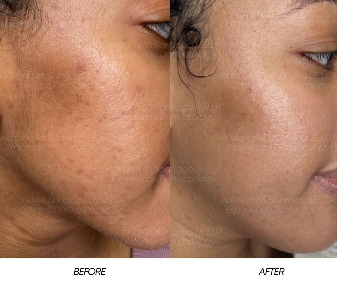 Side-by-side close-up of a cheek before and after treatment, showing reduced dark spots.