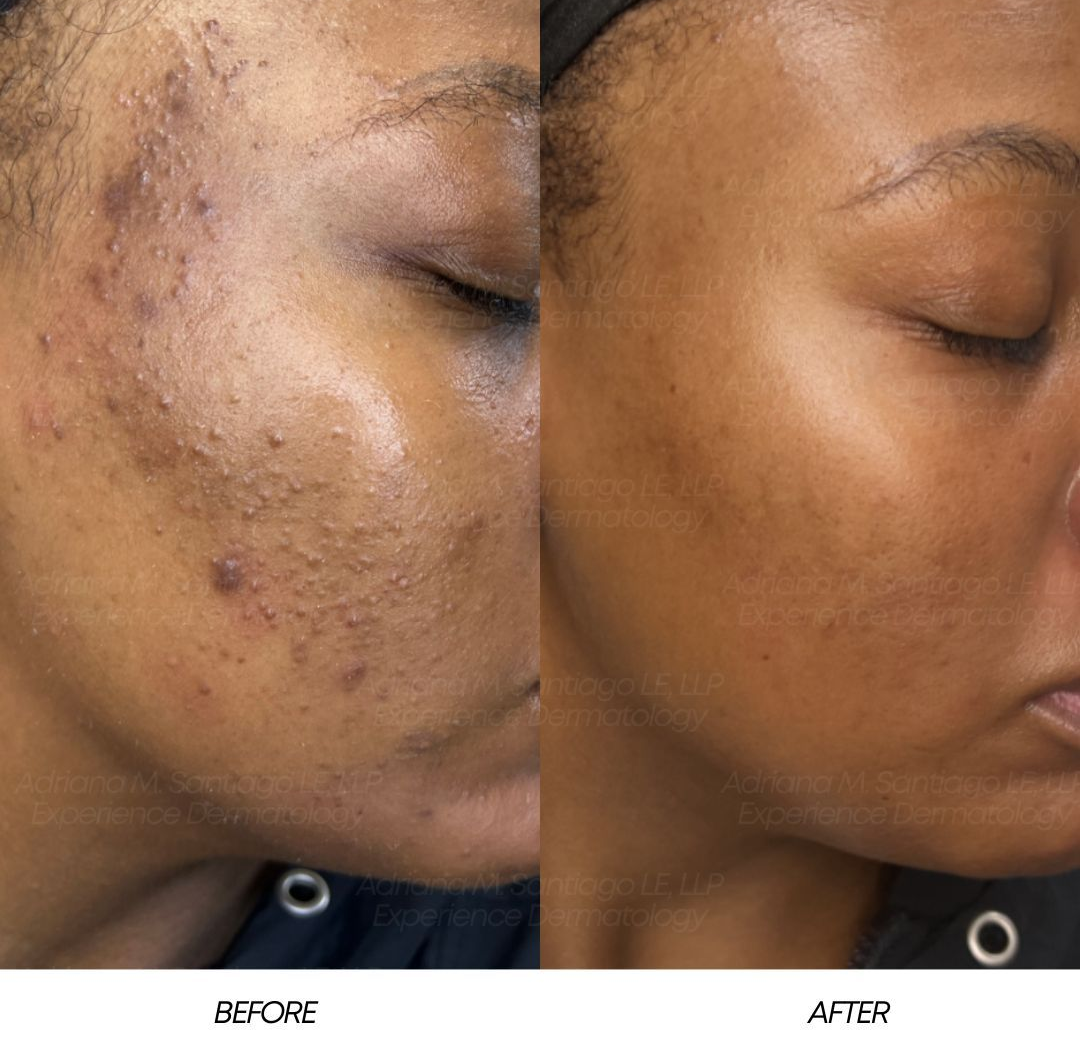 Before-and-after close-up of a cheek showing acne scars and smoother skin improvement