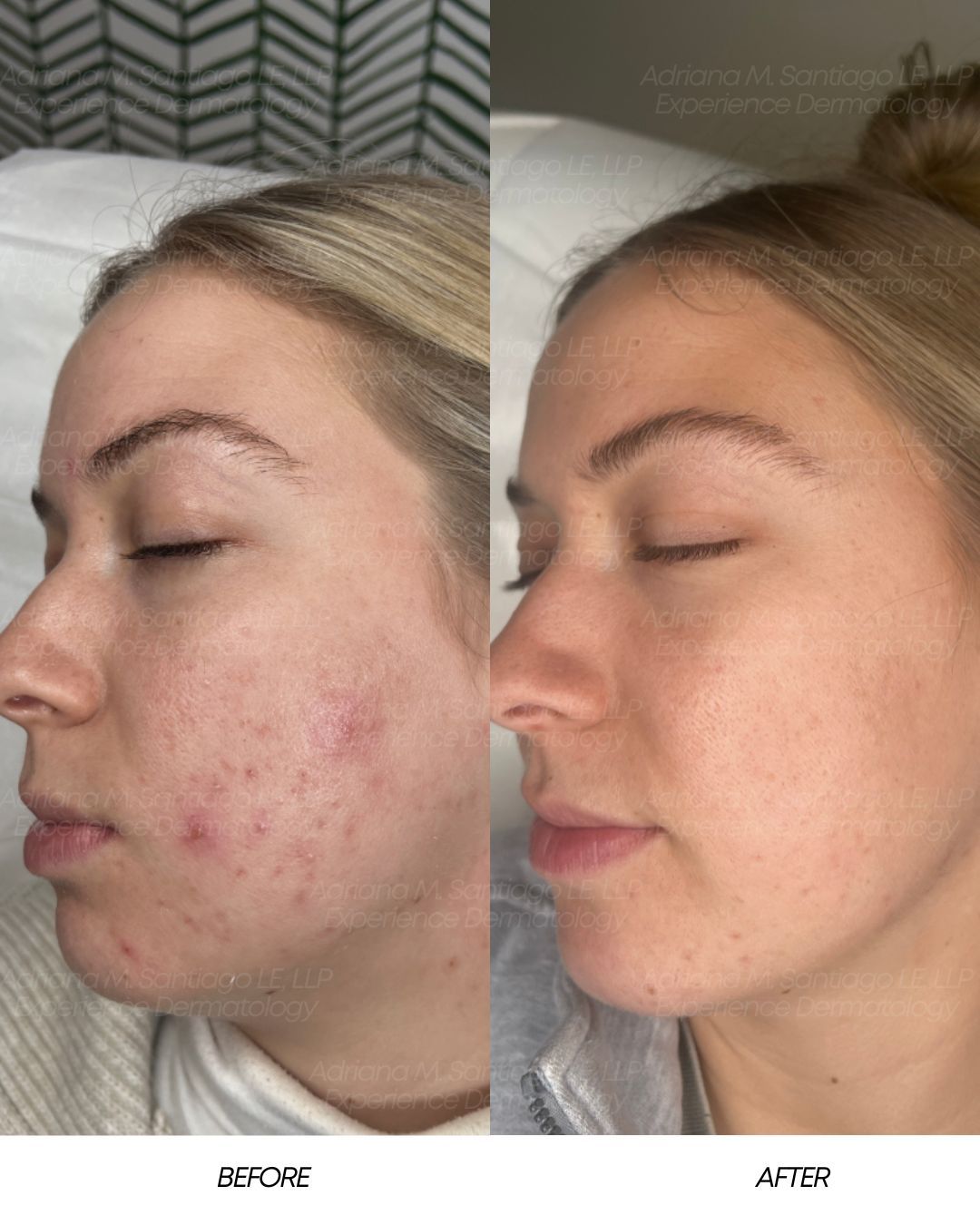 Side-by-side profile photos showing acne on one cheek before and smoother skin after treatment.