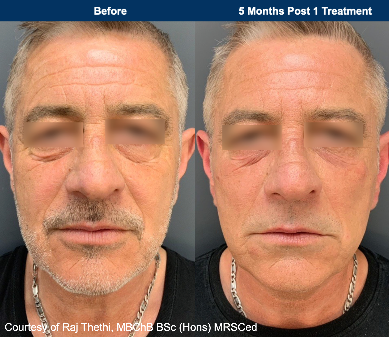 Side-by-side facial photos labeled before and 6 months after treatment, showing reduced under-eye puffiness.