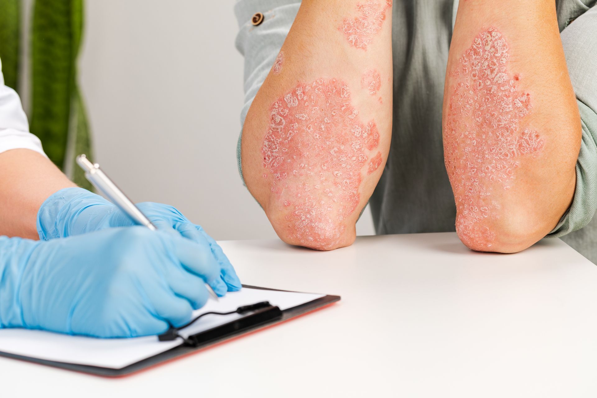 Gloved clinician writing on clipboard beside patient’s red, scaly legs and knees in a clinic setting