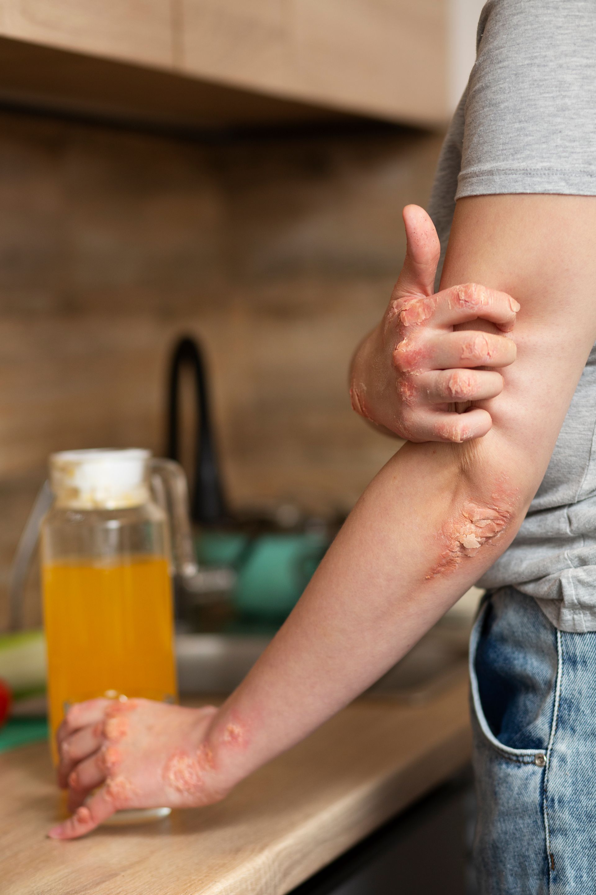 Person with a red, irritated forearm holding a drink at a kitchen counter.