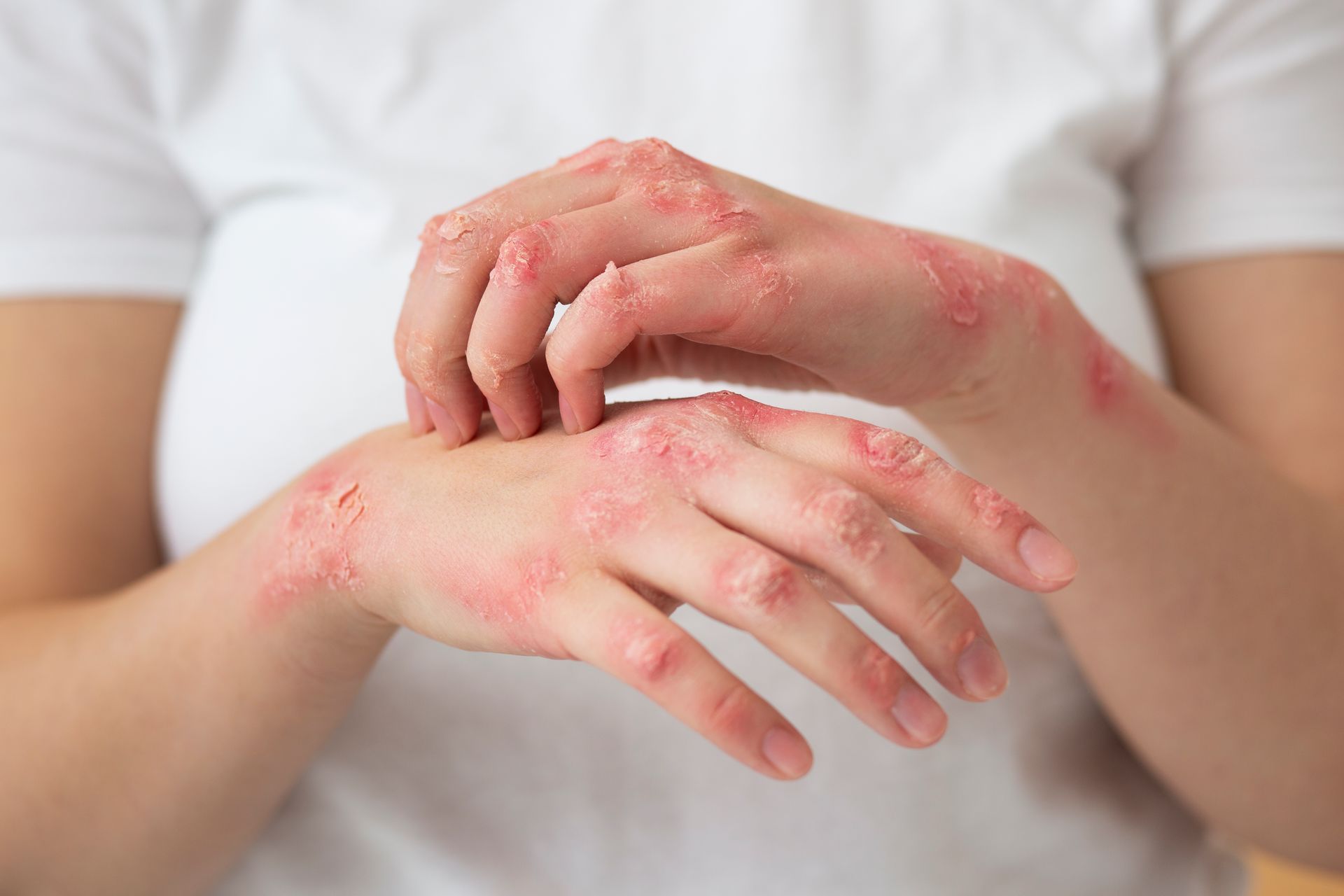 Hands with red, irritated rash and scratches on the skin