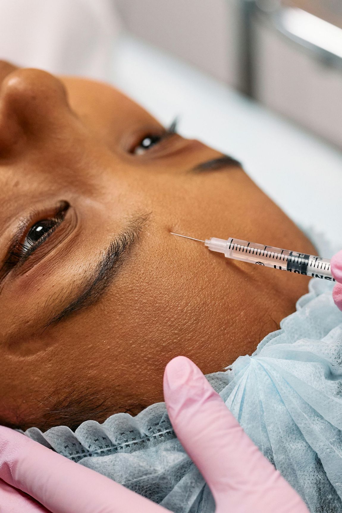 Syringe injecting facial skin during a cosmetic procedure, with gloved hand and blue drape.