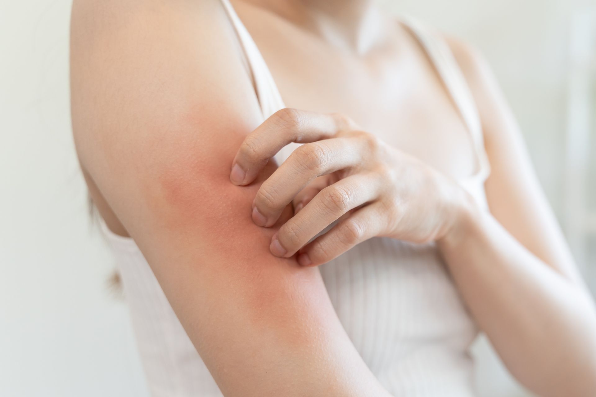 Hand scratching a red, irritated upper arm against a white background
