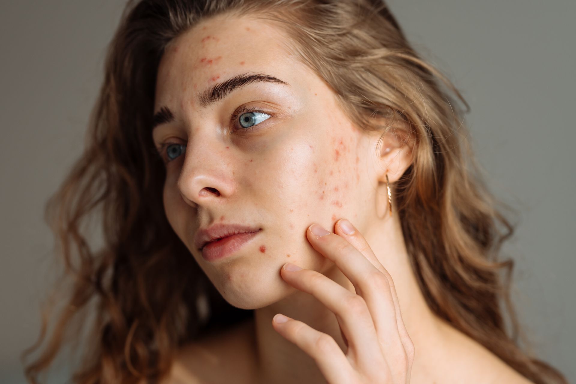 Close-up of a woman touching her cheek with visible acne, looking thoughtfully to the side.