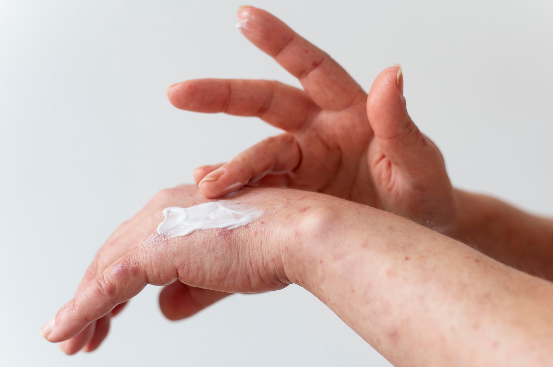 Hands applying white cream to a forearm on a light background
