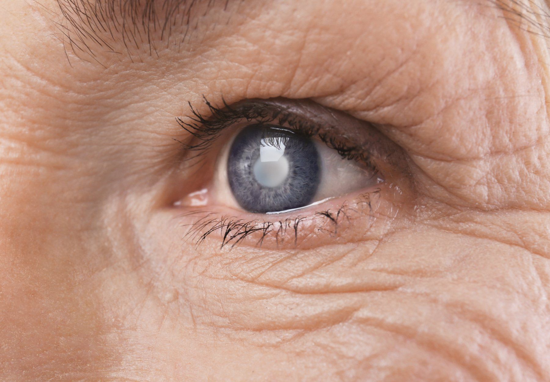 elderly woman's eye with cataracts