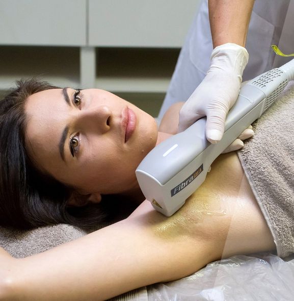 epilazione laser