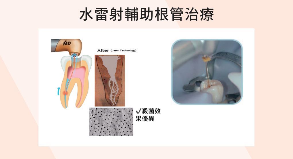 尊兆牙醫家庭牙科療程中，水雷射根管治療的示意圖