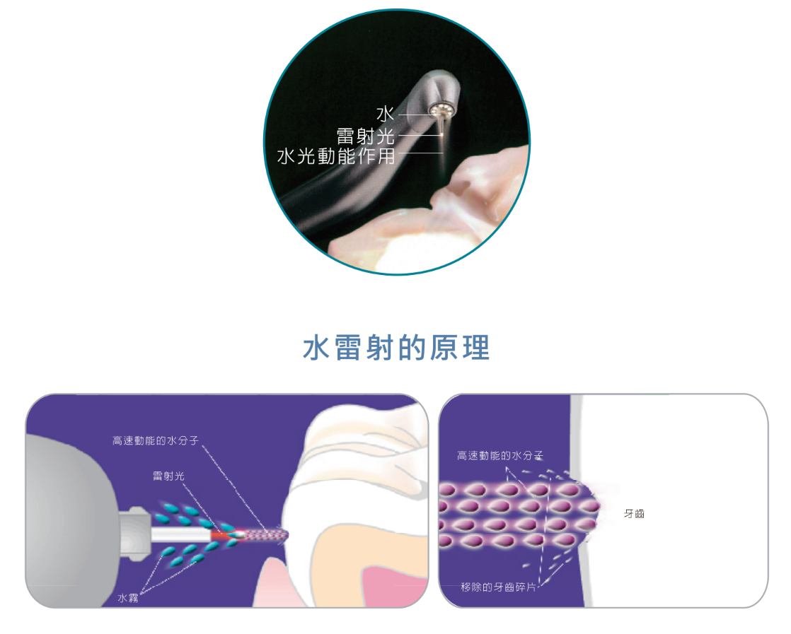 水雷射牙周治療原理示意圖|尊兆牙醫診所