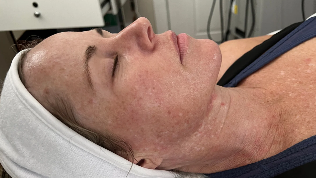 Vrouw met gesloten ogen ondergaat een gezichtsbehandeling, liggend op een behandelbank; haar huid heeft veel pigmentvlekken.