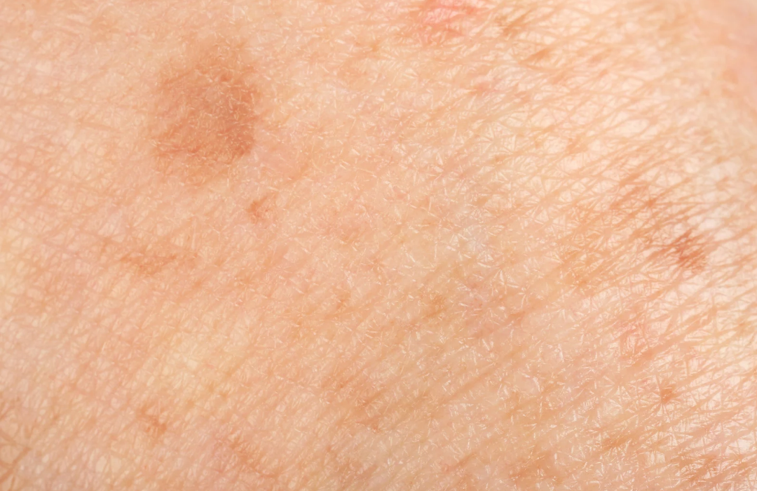 A close up of a person 's skin with pigment spots on it.