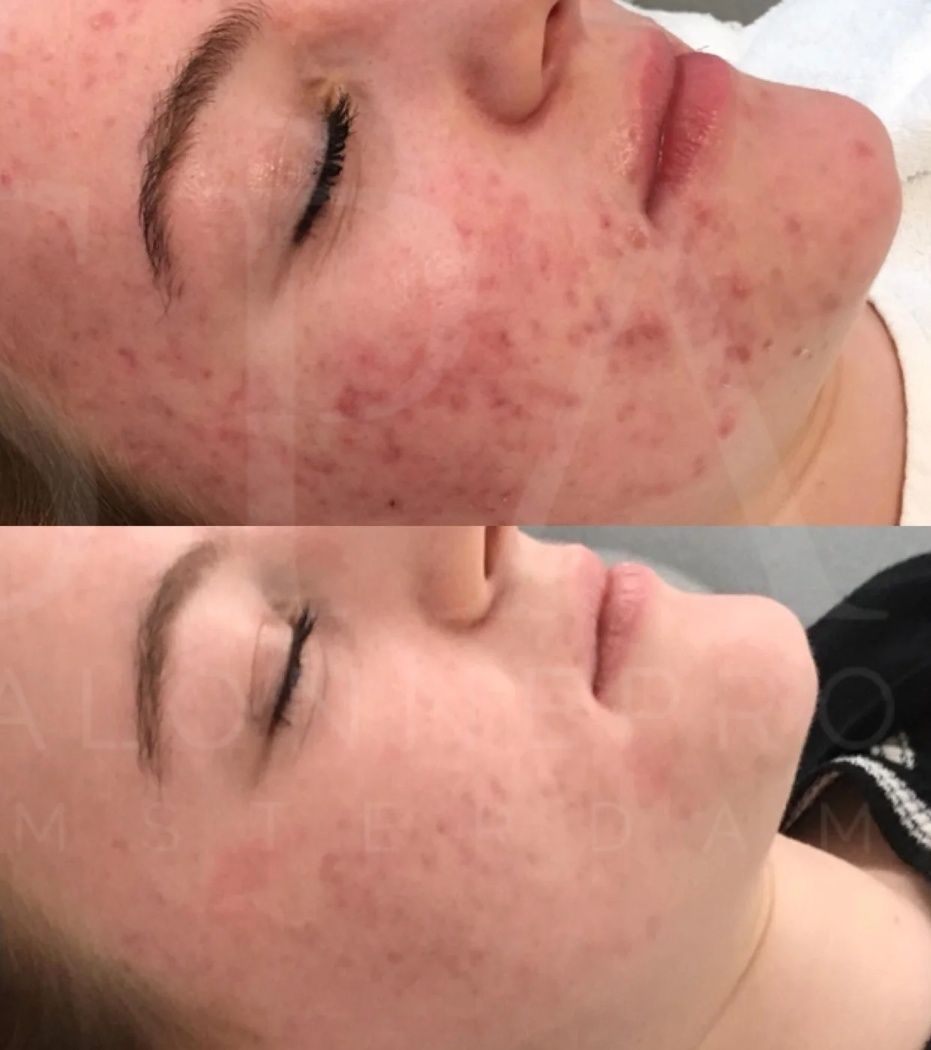 SPA Salonnepro - Acne Set