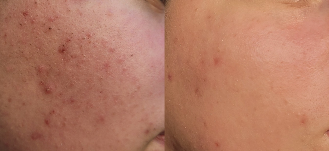Huidvergelijking: Voorheen met acne, daarna met een verbeterde textuur en minder oneffenheden.