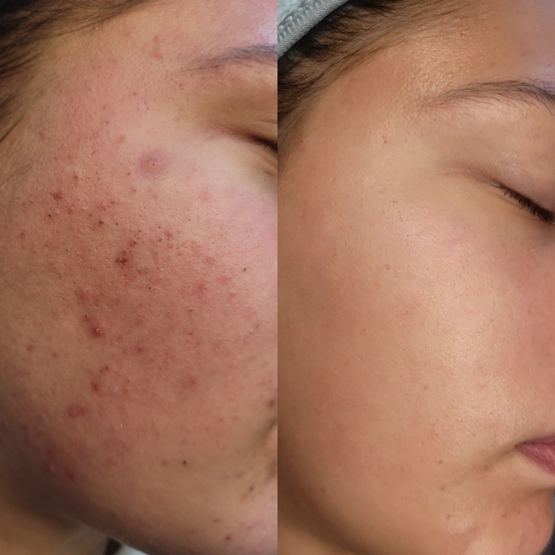 Vergelijking van een gezicht naast elkaar; voor (links) met acne, na (rechts) met een egale huid.