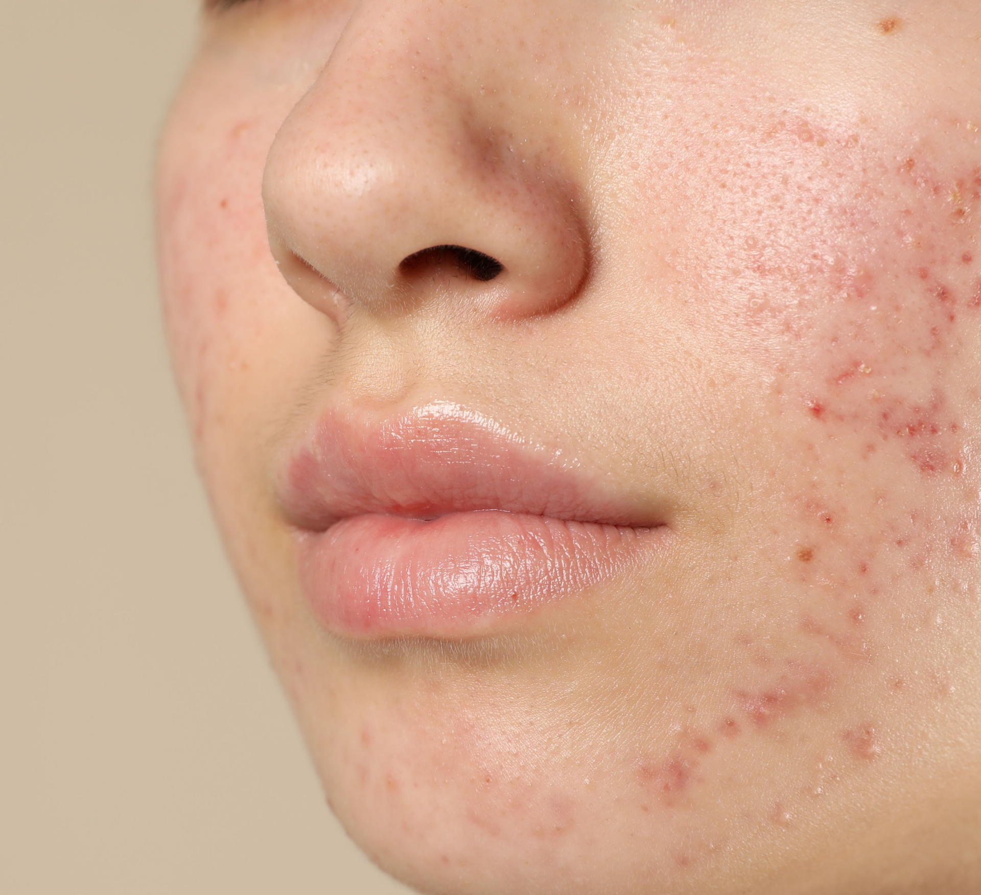 Een persoon met acne brengt crème aan op zijn gezicht.