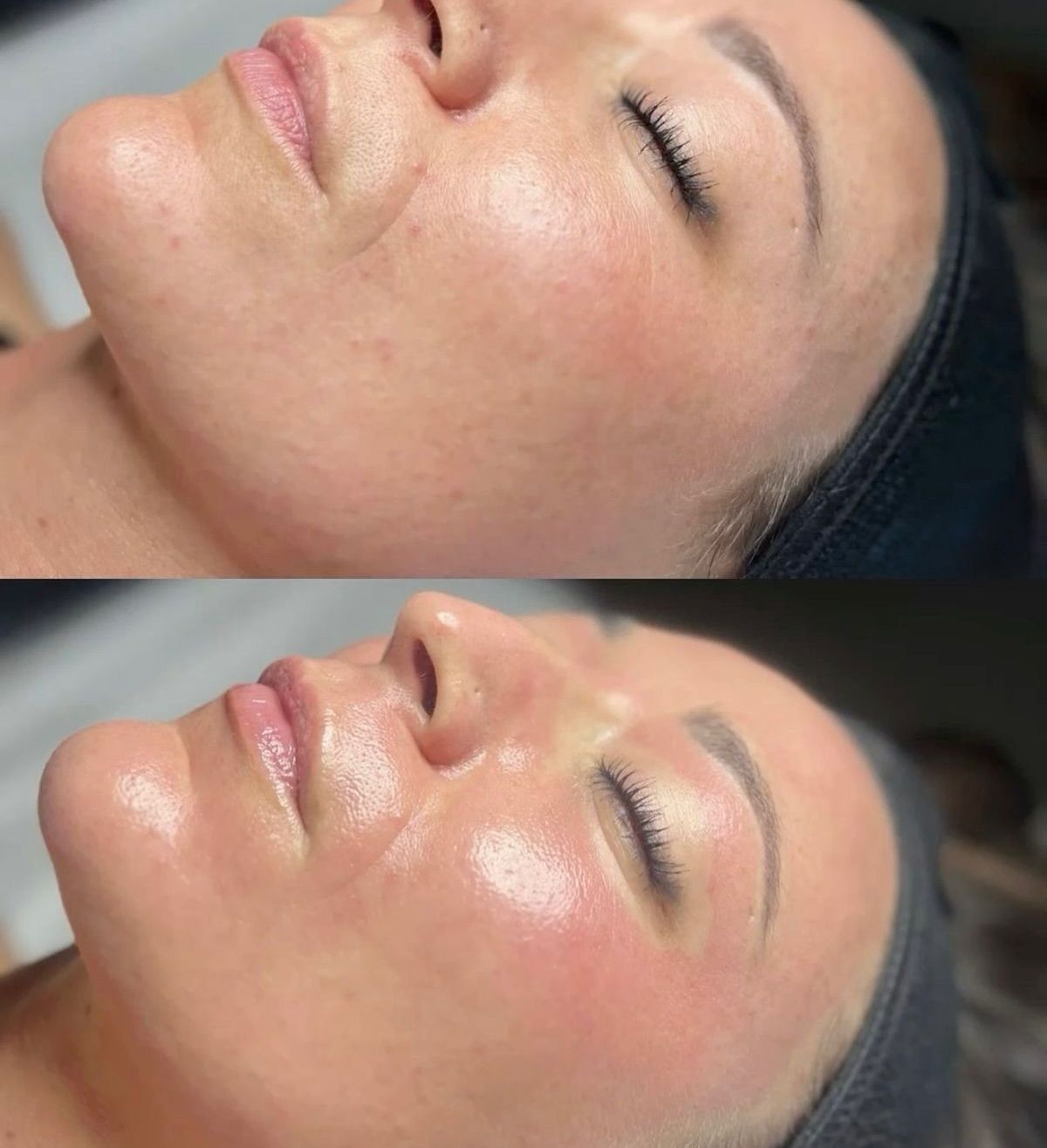 Primer plano comparativo de la mejilla de una mujer antes y después de un tratamiento facial abrillantador.