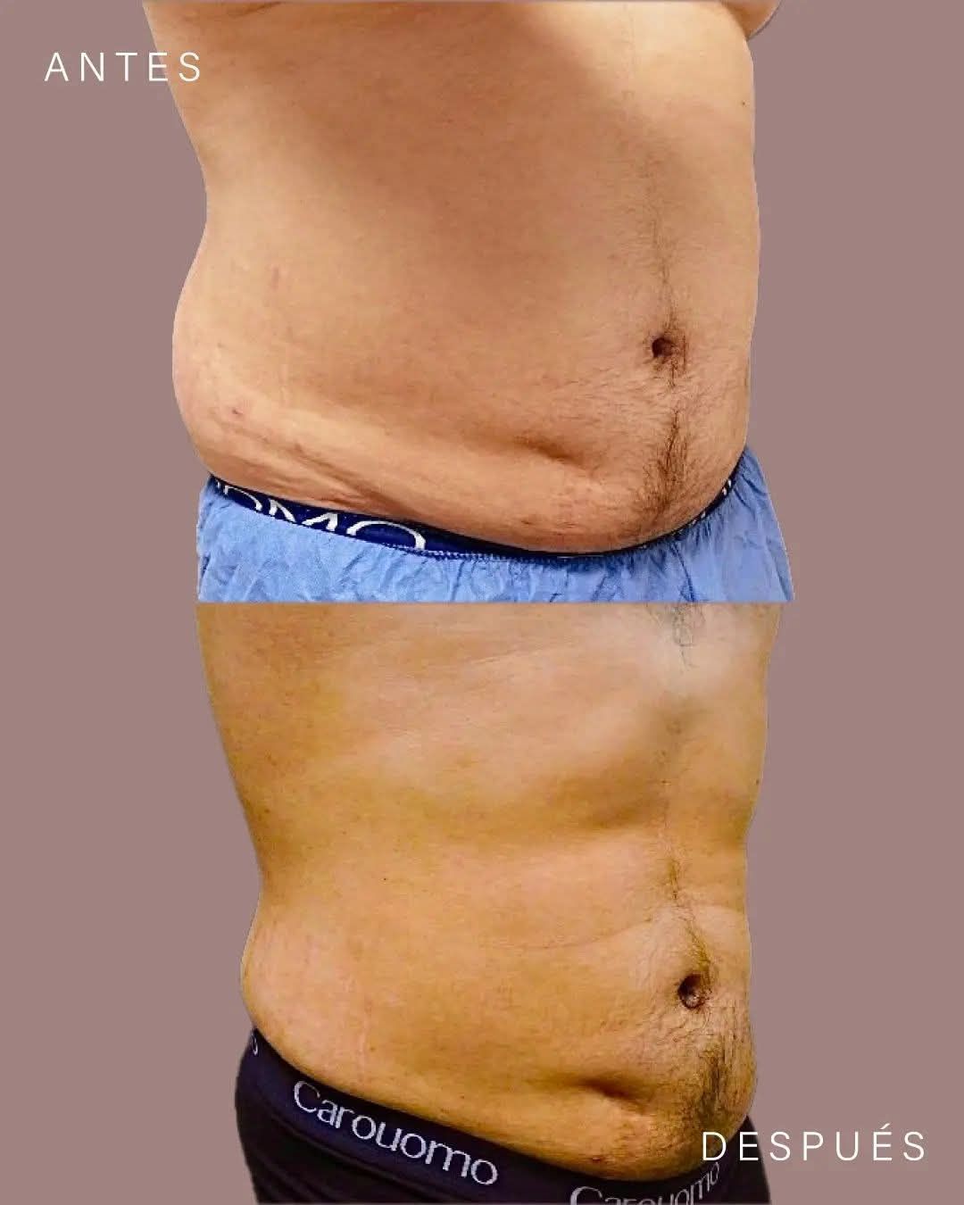Comparación lado a lado del abdomen, etiquetado como “antes” y “después”, que muestra una reducción de la grasa abdominal después del tratamiento.