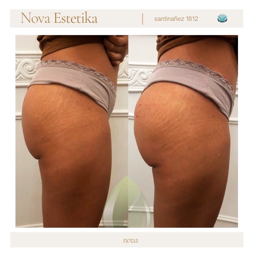 Fotografías comparativas del antes y el después de la zona de la cadera y el muslo de una persona, que muestran un contorno más suave en el lado derecho.
