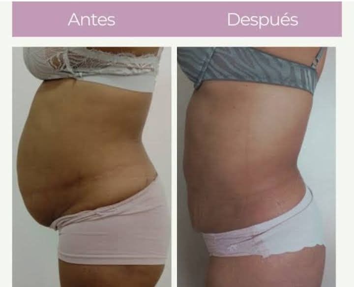 Antes y después del abdomen: foto comparativa de perfil mostrando menor volumen abdominal.