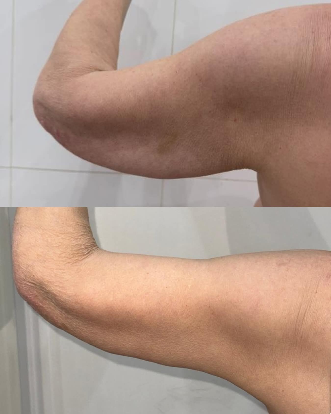 Fotografías comparativas de la parte superior del brazo flexionado que muestran una piel tersa bajo diferentes condiciones de iluminación.