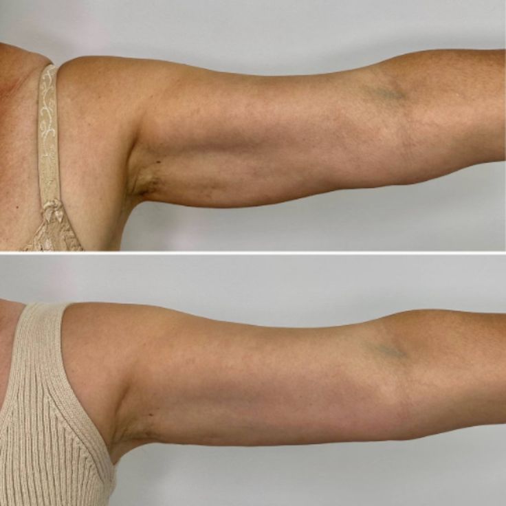 Vista lateral de un brazo extendido, con una comparación del antes y el después para mostrar un brazo superior más delgado.