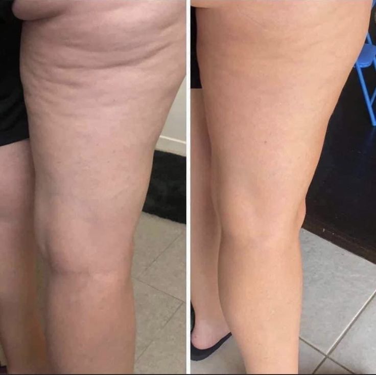 Primer plano comparativo de una pierna antes y después del tratamiento para lograr una piel más suave.