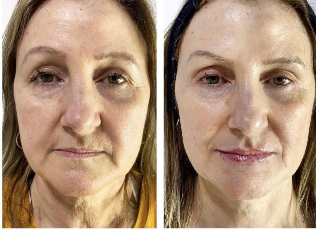 Primeros planos faciales uno al lado del otro: antes y después del tratamiento de la piel, con la piel más suave a la derecha.
