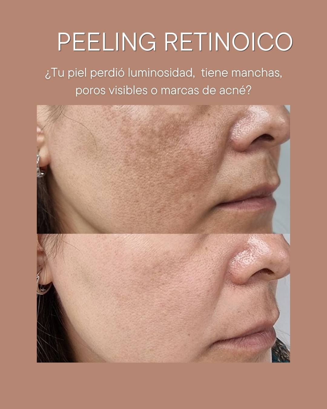 Antes y después de un peeling retinoico en la mejilla, mostrando menos manchas y textura más uniforme.