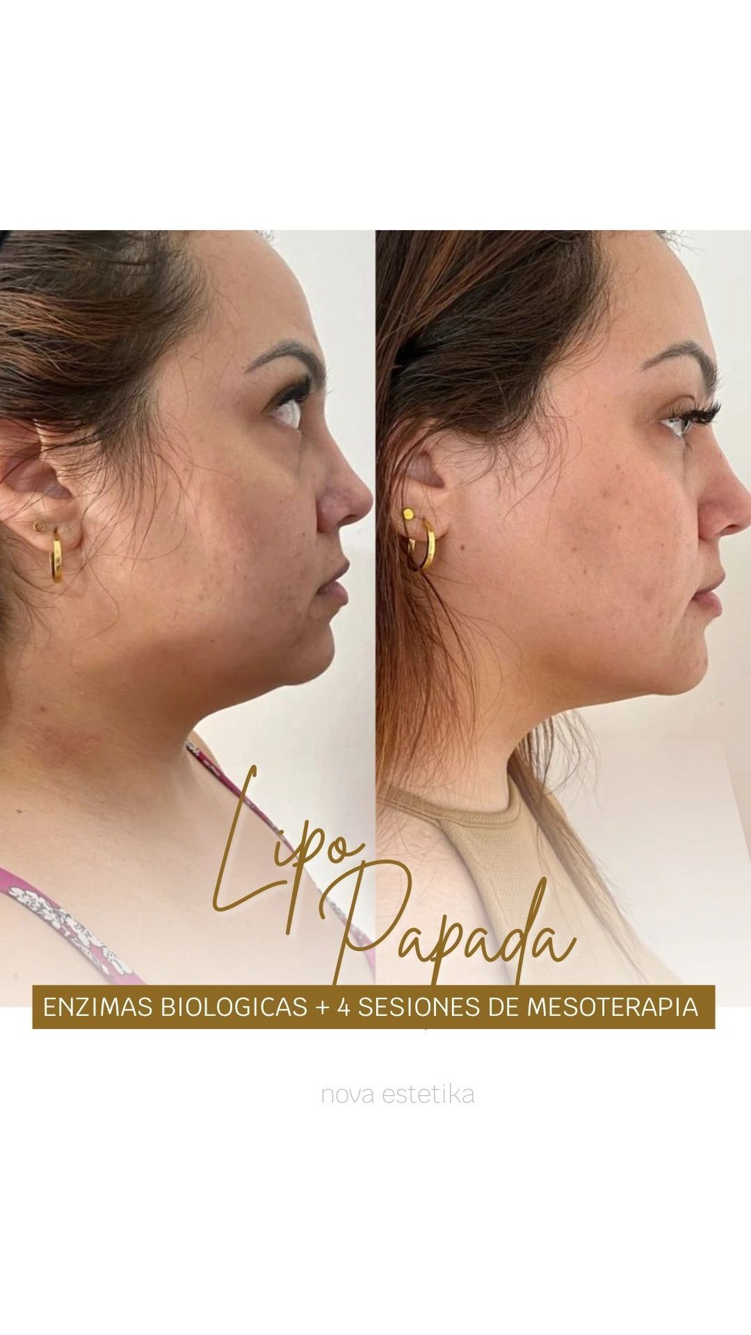 Fotografías de perfil facial una al lado de la otra que muestran una comparación de la nariz antes y después, con una firma y texto superpuestos.