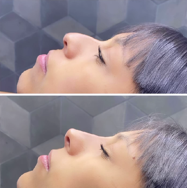 Primer plano comparativo del perfil de una persona con cabello oscuro, mostrando el antes y el después del contorneado de la nariz.