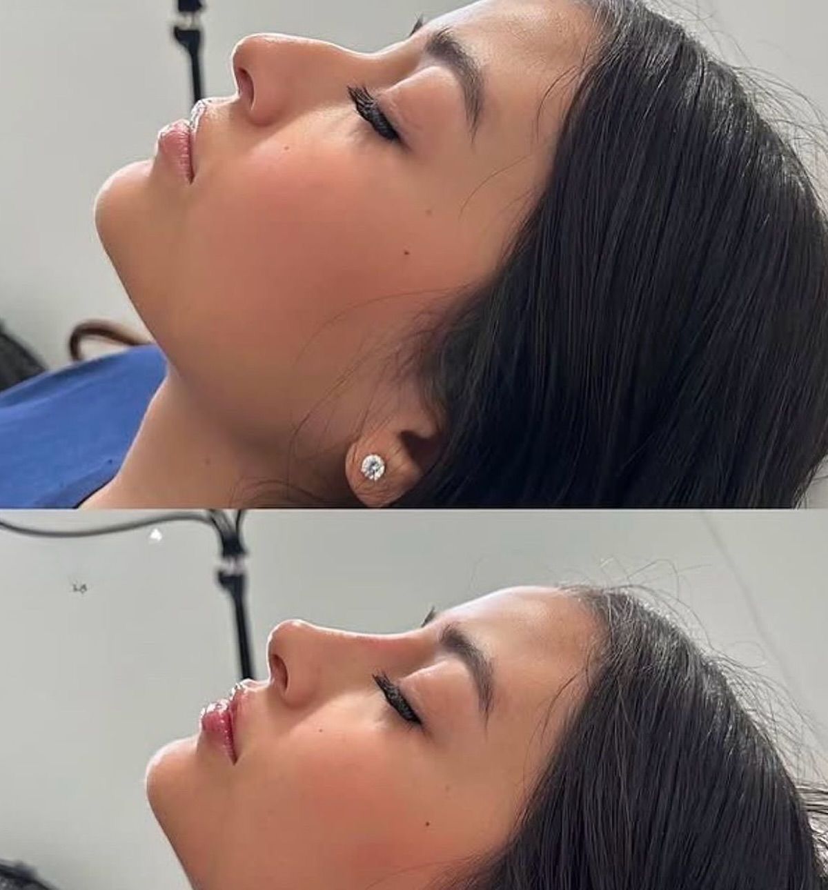 Sculptra es un bioestimulador de colágeno inyectable, diseñado para combatir la flacidez y mejorar la calidad de la piel. A diferencia de los rellenos dérmicos tradicionales, este tratamiento estimula la producción natural de colágeno del cuerpo, restaurando la firmeza, volumen y suavizando arrugas profundas