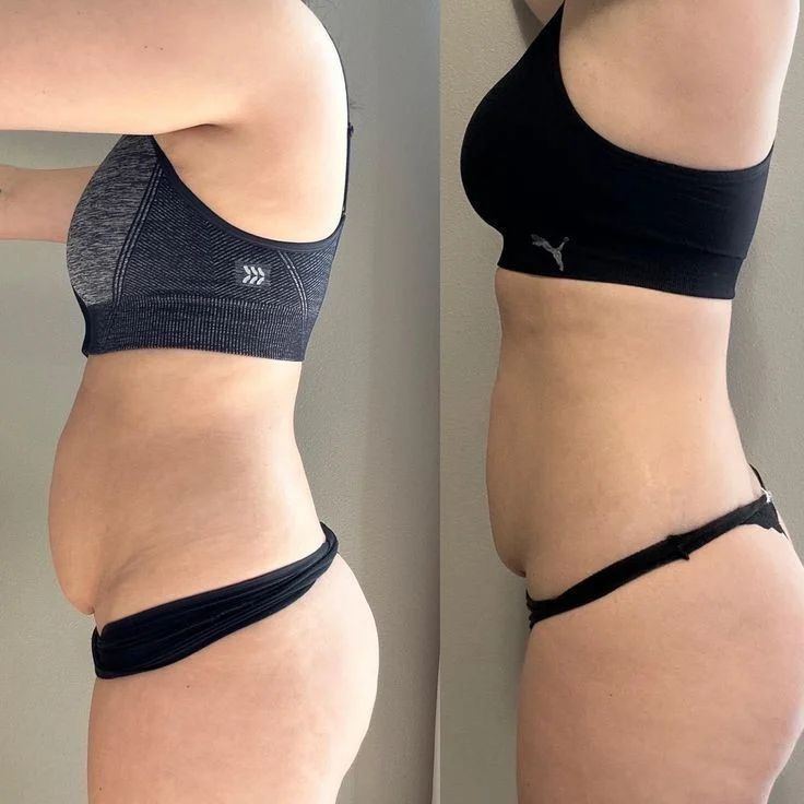 Fotografías comparativas del torso, en ropa deportiva, que muestran una cintura y una sección media más delgadas en el lado derecho.
