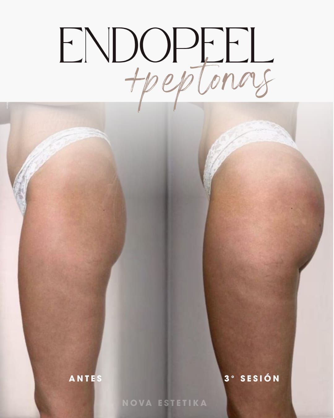 Foto de antes y después de unas nalgas con reducción de celulitis, etiquetadas como “antes” y “3ª sesión”.