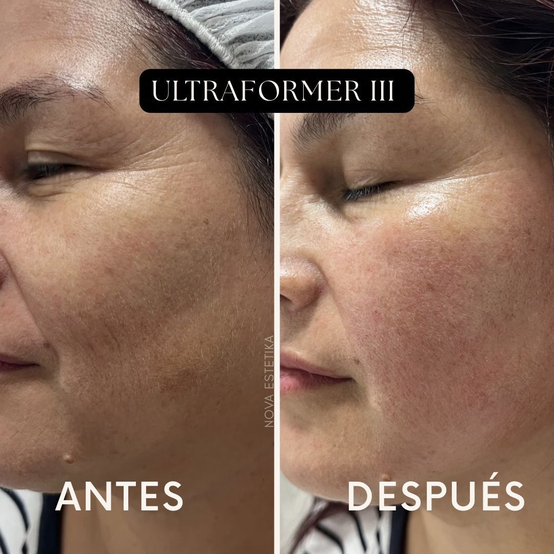 Comparación de tratamientos faciales con la etiqueta 
