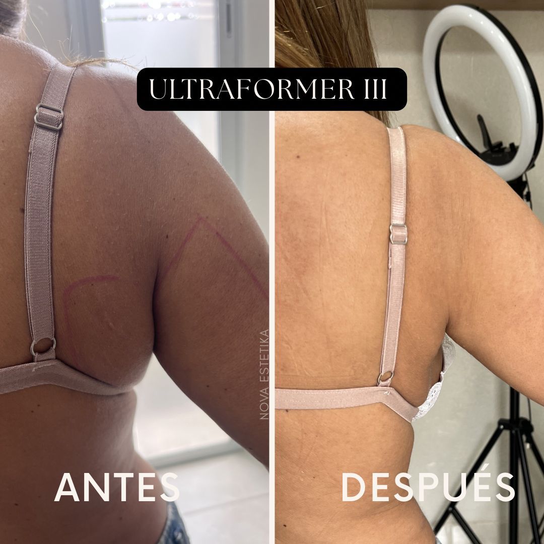 Comparación lado a lado del torso, etiquetada como “ANTES” y “DESPUÉS”, que muestra una cintura y una espalda más delgadas.