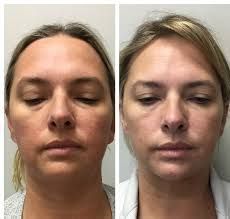 Fotografías faciales comparativas que muestran la reducción de la hinchazón, con los ojos cerrados y expresiones neutras.