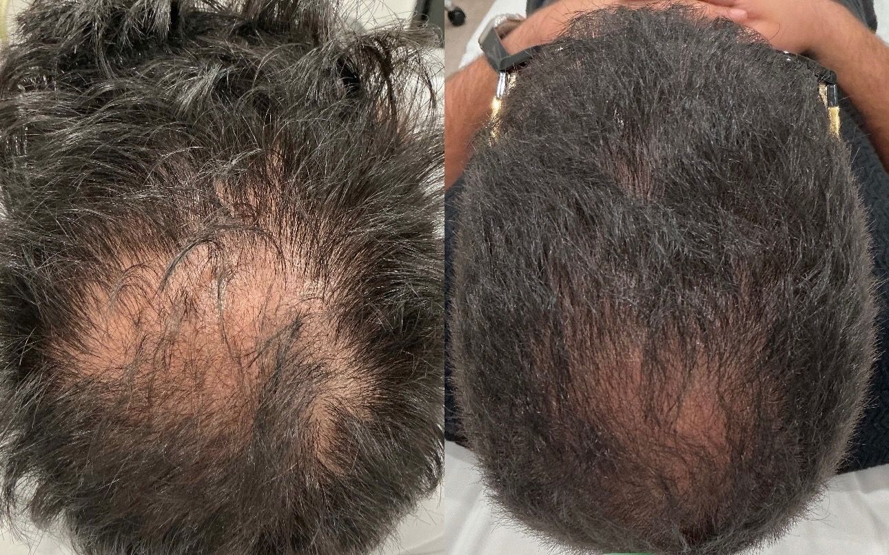 Comparison of a person's head, showing hair growth before and after treatment. Comparison of a person's head, showing hair growth before and after treatment.