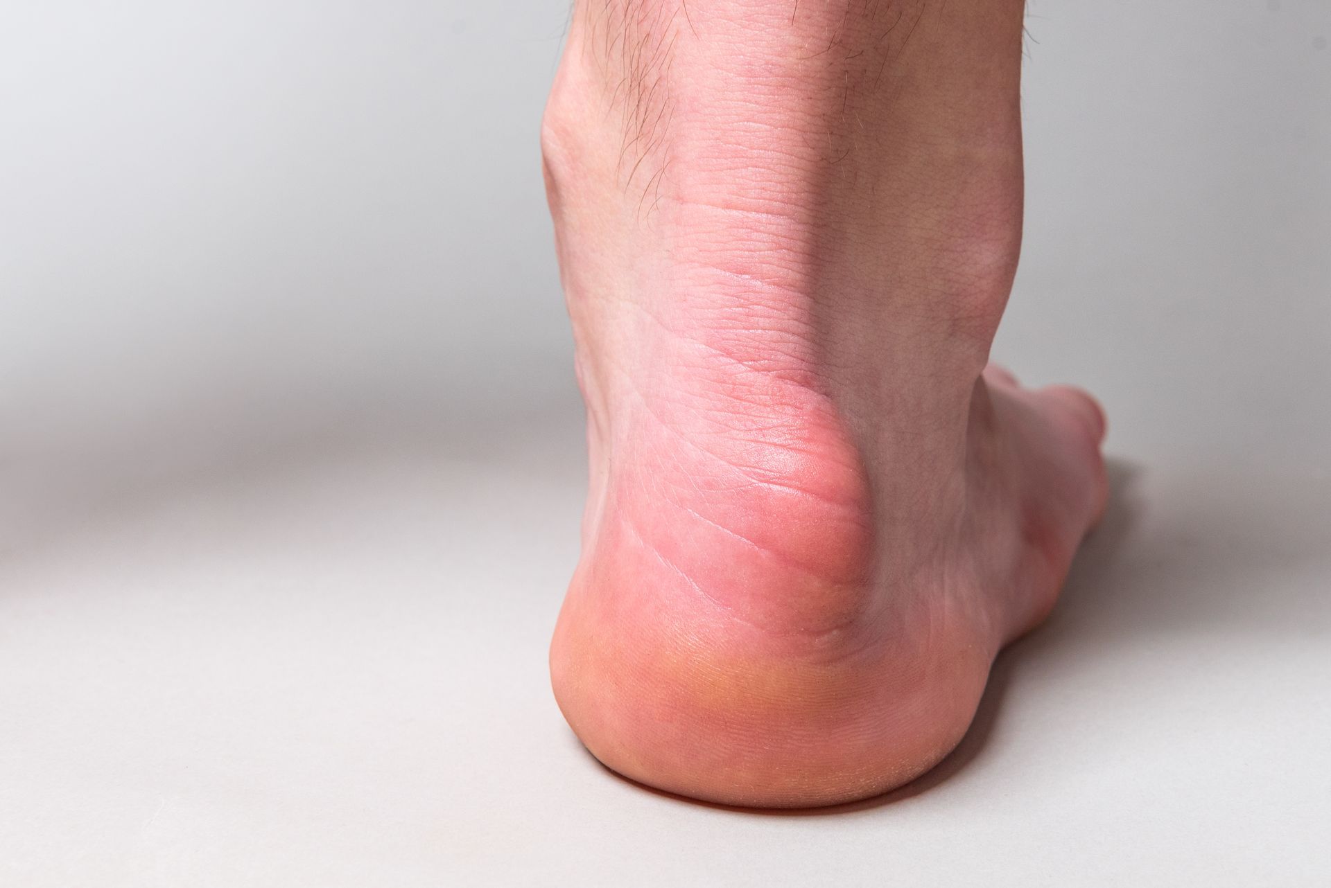 A close-up of a person's heel, red and swollen, indicating possible injury or irritation.