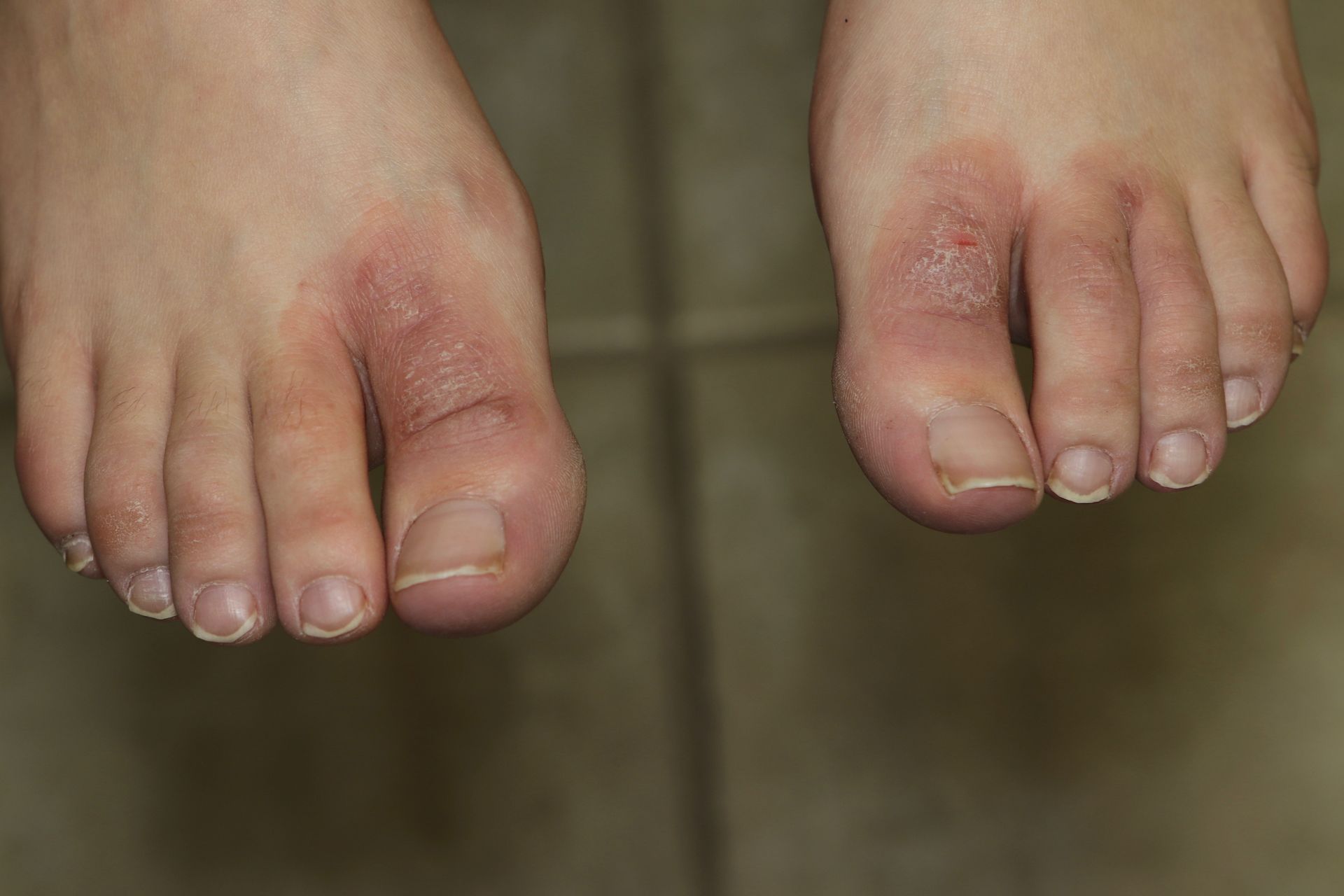 Two feet with red, irritated skin between the toes, possibly an infection.