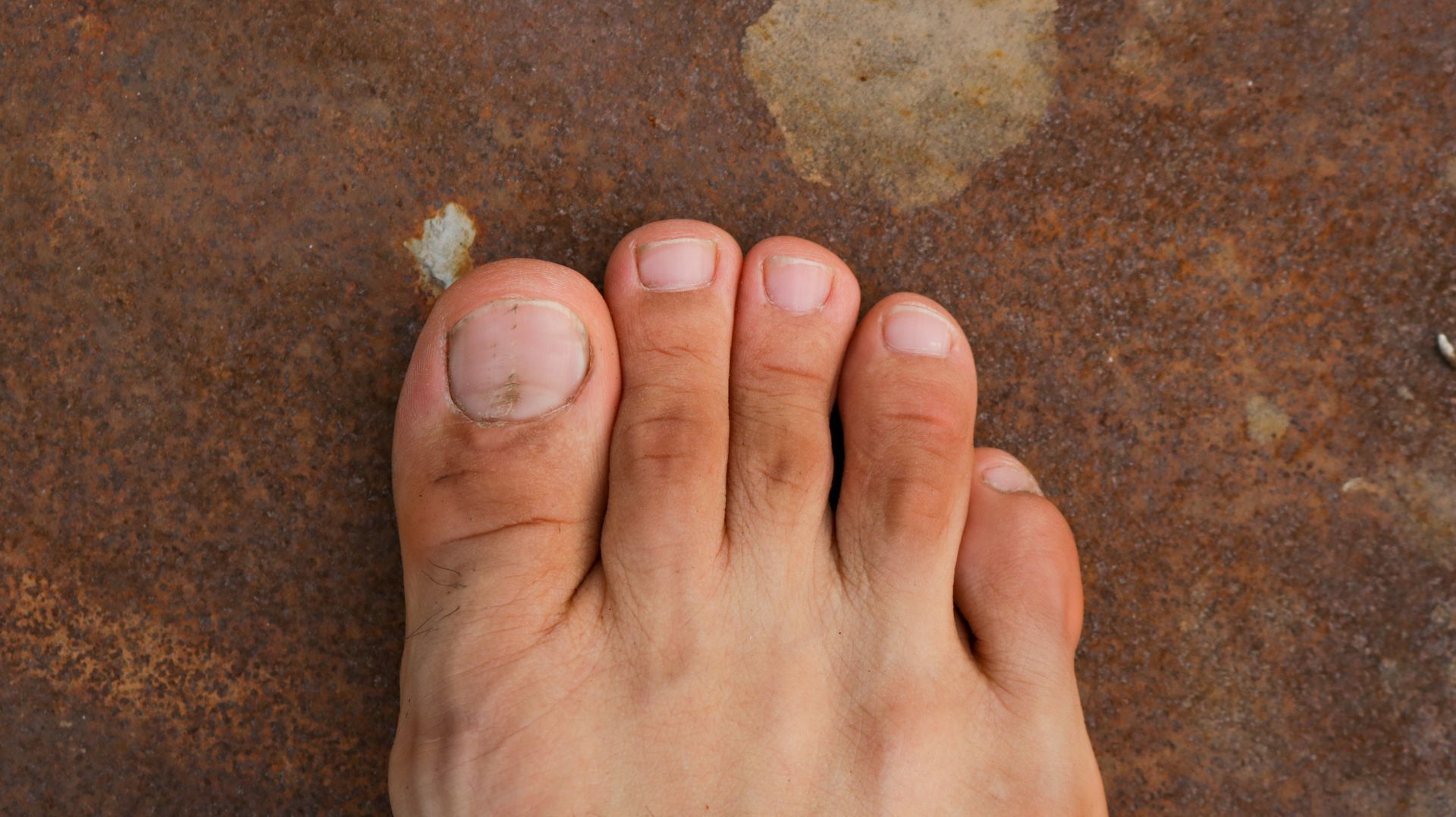 Bare foot on a rusty brown surface; big toe has a stained nail.