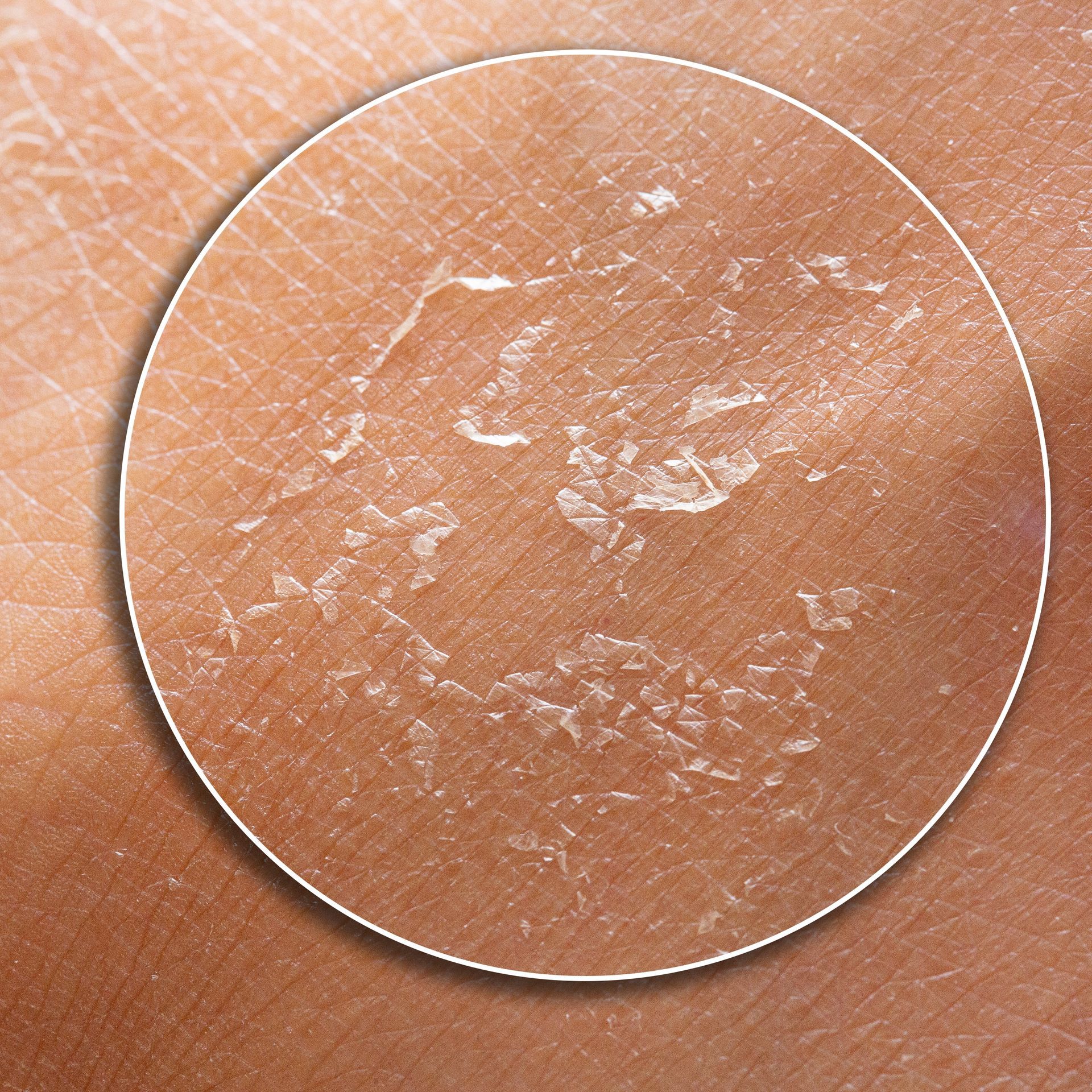 Close-up of dry, peeling skin. Brown skin with flaky, white patches.