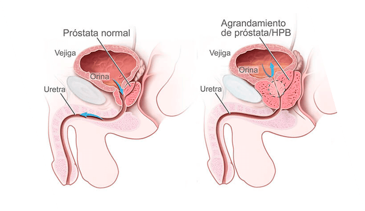 DR. JAVIER MEDRANO SÁNCHEZ: Próstata