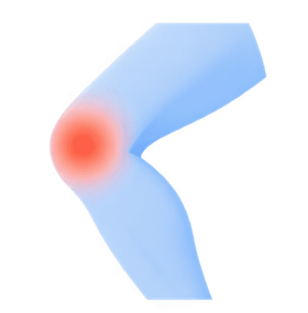 Knee pain illustration