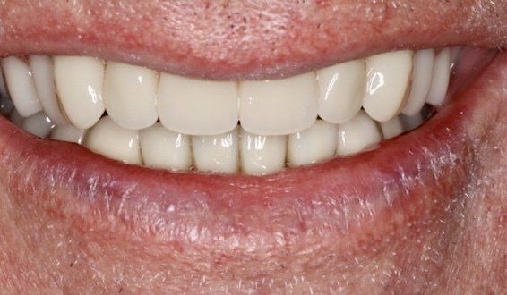 Dental veneers in Osborne, KS to repair and reshape teeth.