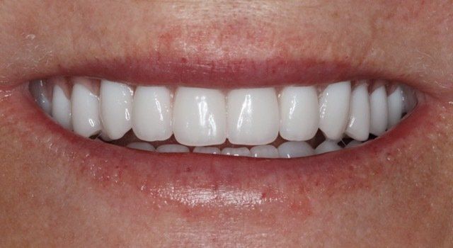 Durable dental implants in Osborne, KS for lasting results.