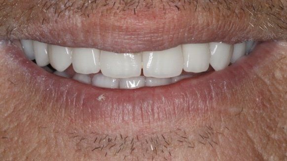 Dental veneers in Osborne, KS to repair and reshape teeth.